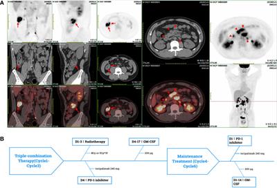 PD-1 inhibitor combined with radiotherapy and GM-CSF in MSS/pMMR metastatic colon cancer: a case report